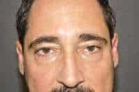 Male Eyelid Lift