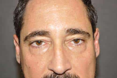 Male Eyelid Lift