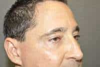 Male Eyelid Lift