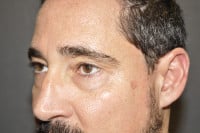 Male Eyelid Lift