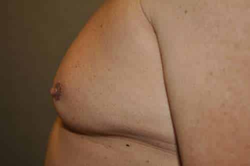 Nipple Reduction