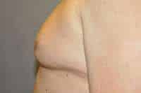 Nipple Reduction