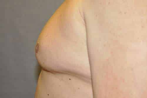 Nipple Reduction