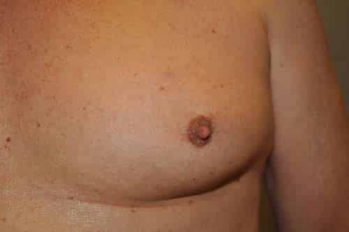 Nipple Reduction