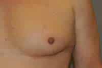 Nipple Reduction