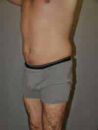 Liposuction