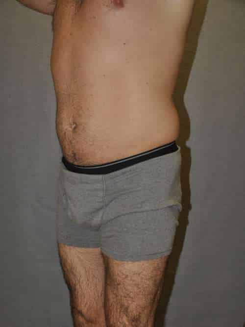 Liposuction