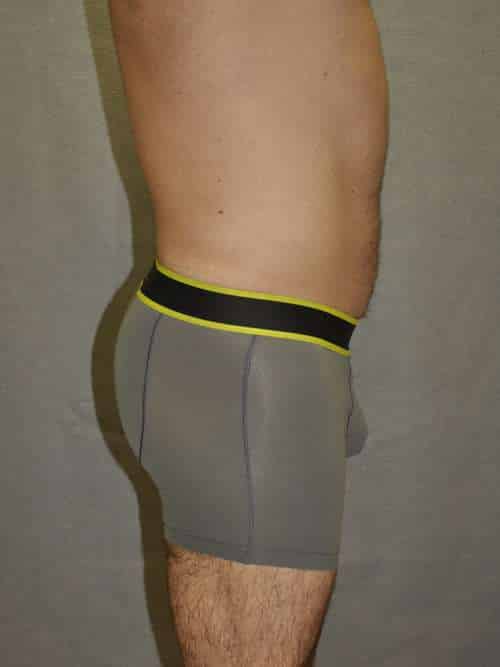 Liposuction