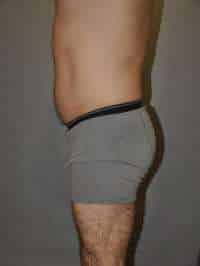 Liposuction