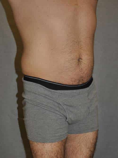 Liposuction