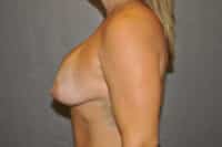Breast Lift