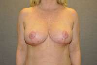 Breast Lift