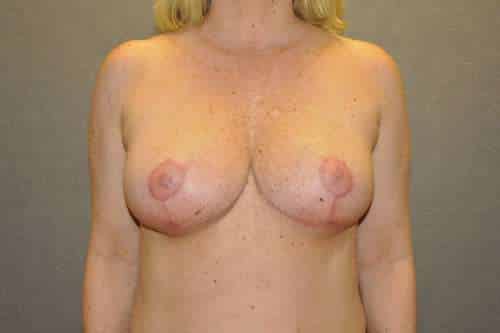 Breast Lift