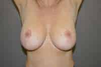 Breast Lift