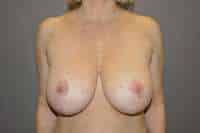 Breast Lift
