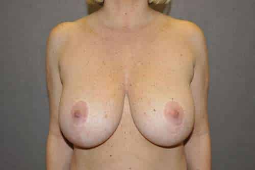 Breast Lift