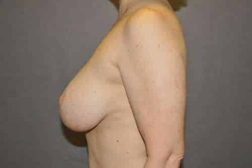 Breast Lift