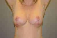 Breast Lift