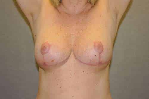 Breast Lift