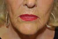 Dermabrasion