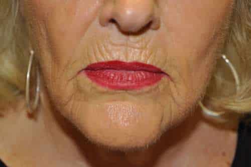 Dermabrasion