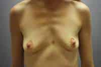 Breast Augmentation