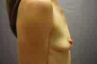 Breast Augmentation