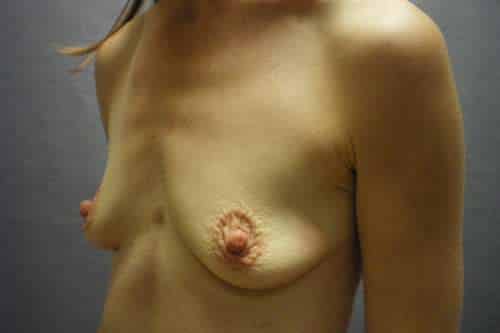 Breast Augmentation