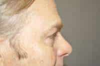 Male Eyelid Lift