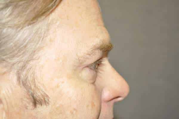 Male Eyelid Lift