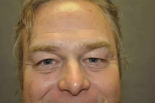 Male Eyelid Lift