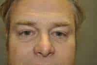 Male Eyelid Lift
