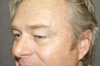 Male Eyelid Lift