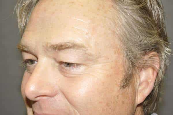 Male Eyelid Lift