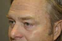 Male Eyelid Lift