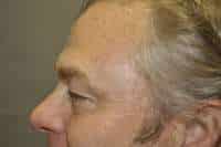 Male Eyelid Lift