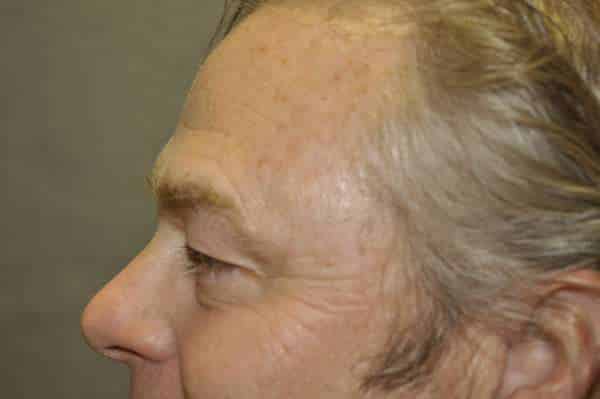 Male Eyelid Lift