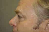Male Eyelid Lift
