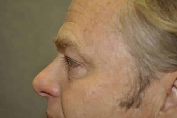Male Eyelid Lift