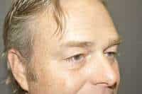 Male Eyelid Lift