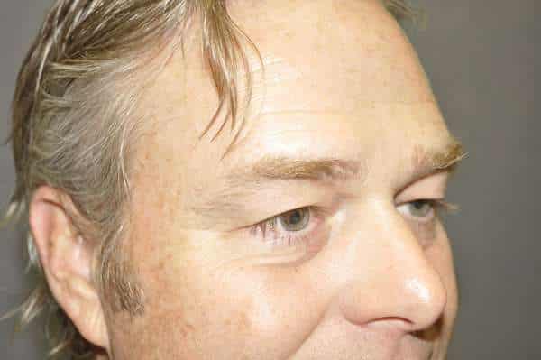 Male Eyelid Lift