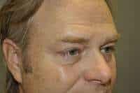 Male Eyelid Lift