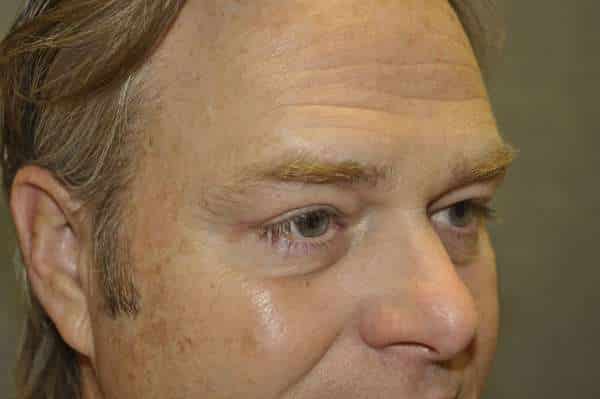 Male Eyelid Lift