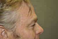 Male Eyelid Lift