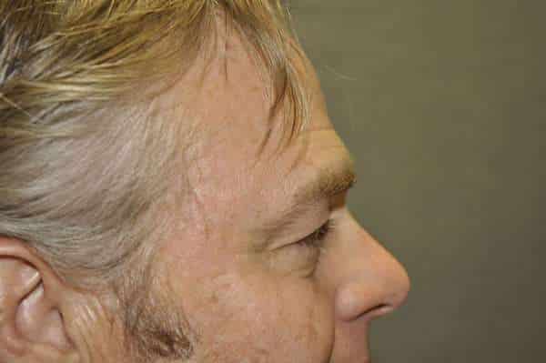 Male Eyelid Lift