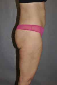 Liposuction