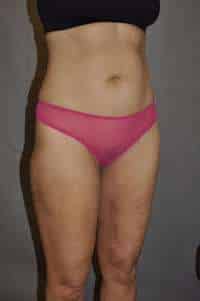 Liposuction