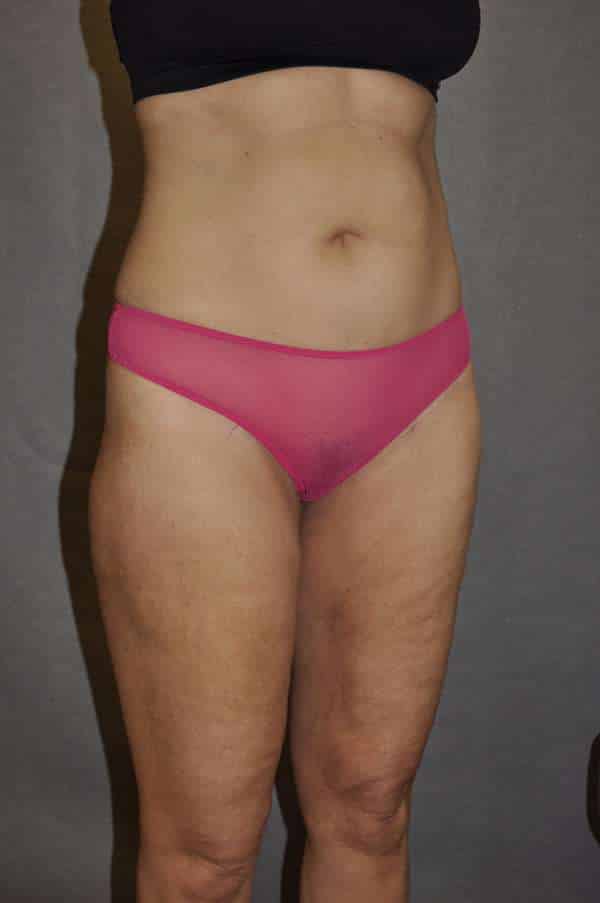 Liposuction