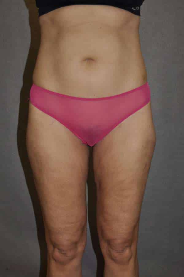Liposuction