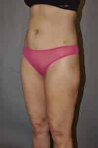 Liposuction